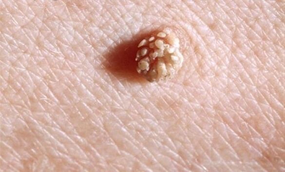Papilloma uz cilvēka ķermeņa